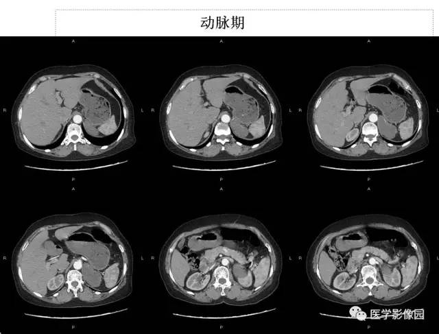 【病例】左侧肾上腺节细胞神经纤维瘤1例CT 【病例】左侧肾上腺节细胞神经纤维瘤1例CT