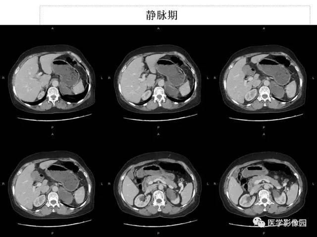 【病例】左侧肾上腺节细胞神经纤维瘤1例CT 【病例】左侧肾上腺节细胞神经纤维瘤1例CT
