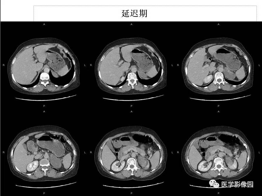 【病例】左侧肾上腺节细胞神经纤维瘤1例CT 【病例】左侧肾上腺节细胞神经纤维瘤1例CT