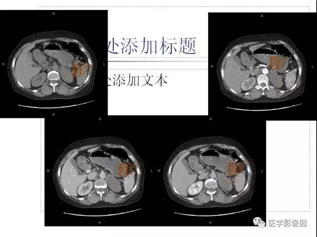 【病例】左侧肾上腺节细胞神经纤维瘤1例CT 【病例】左侧肾上腺节细胞神经纤维瘤1例CT
