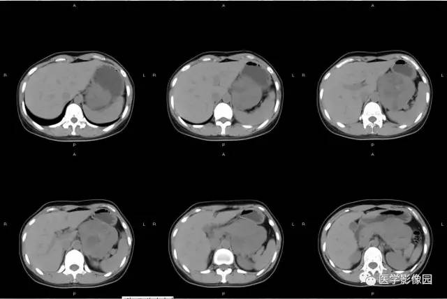 【病例】胰腺实性假乳头状瘤1例CT 【病例】胰腺实性假乳头状瘤1例CT