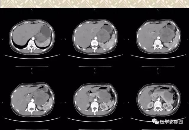 【病例】胰腺实性假乳头状瘤1例CT