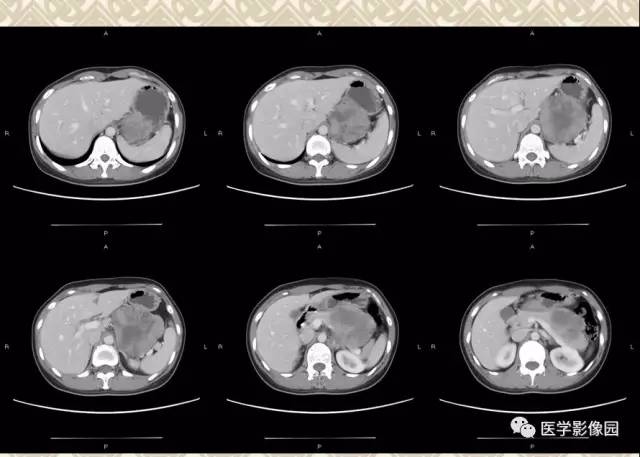 【病例】胰腺实性假乳头状瘤1例CT 【病例】胰腺实性假乳头状瘤1例CT
