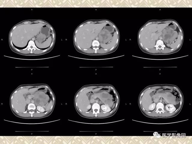 【病例】胰腺实性假乳头状瘤1例CT 【病例】胰腺实性假乳头状瘤1例CT