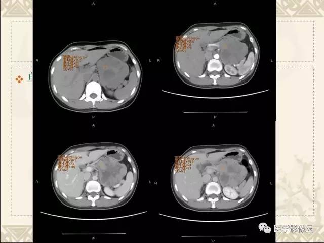 【病例】胰腺实性假乳头状瘤1例CT 【病例】胰腺实性假乳头状瘤1例CT