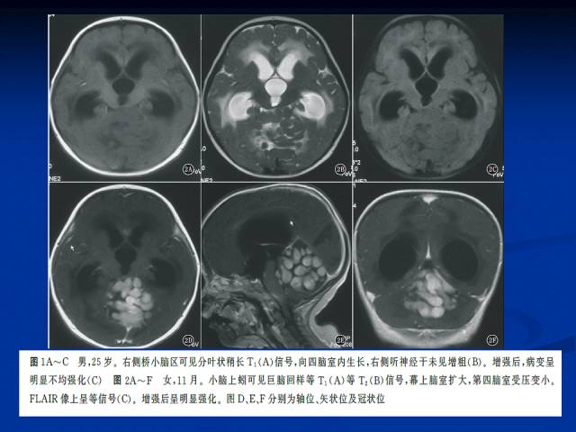 【病例】脉络丛乳头状瘤一例MR