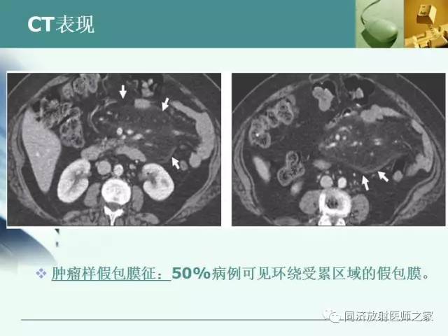 【PPT】肠系膜脂膜炎的CT表现