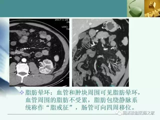 【PPT】肠系膜脂膜炎的CT表现