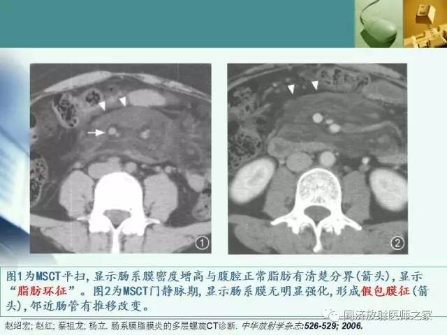 【PPT】肠系膜脂膜炎的CT表现