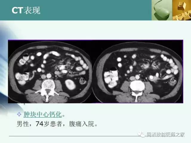 【PPT】肠系膜脂膜炎的CT表现