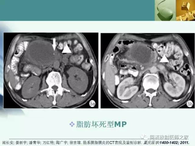【PPT】肠系膜脂膜炎的CT表现