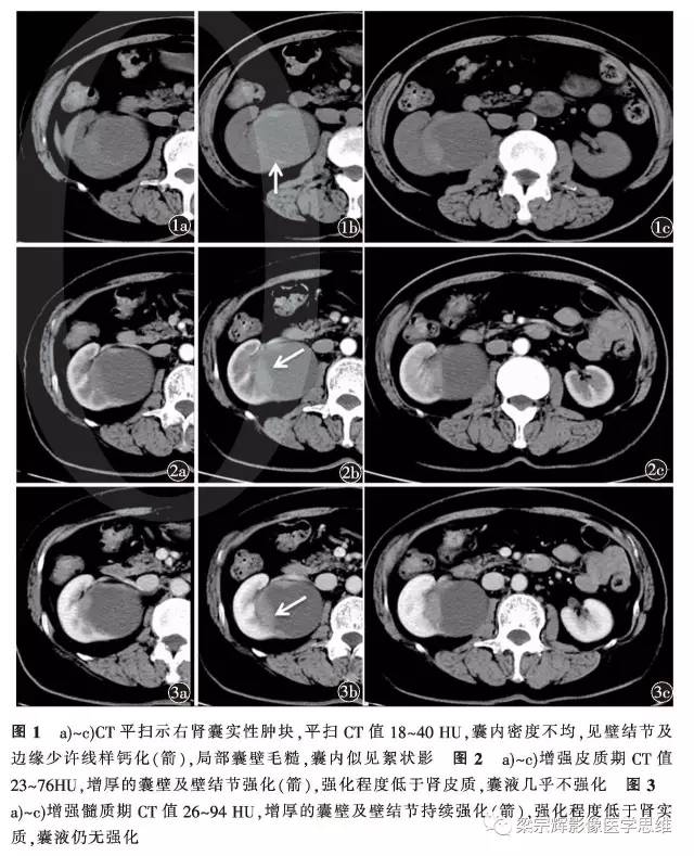 【病例】囊性肾癌1例CT影像表现