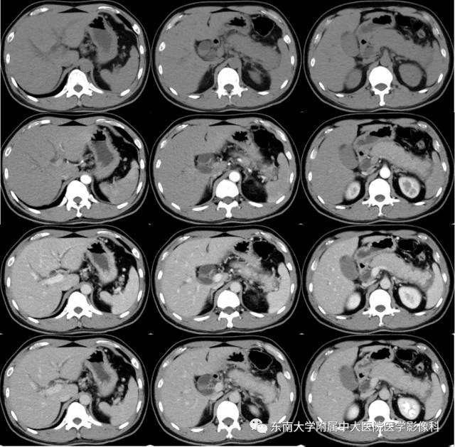 【病例】自身免疫性胰腺炎1例CT及MR影像表现