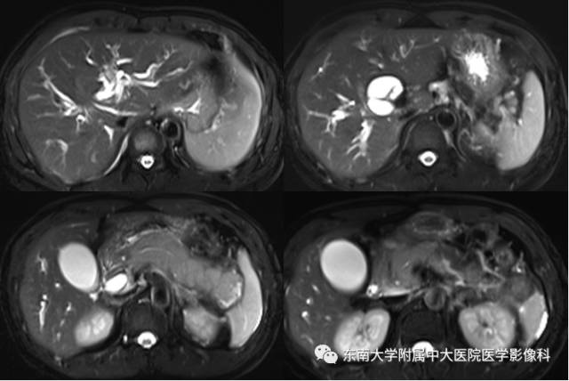 【病例】自身免疫性胰腺炎1例CT及MR影像表现