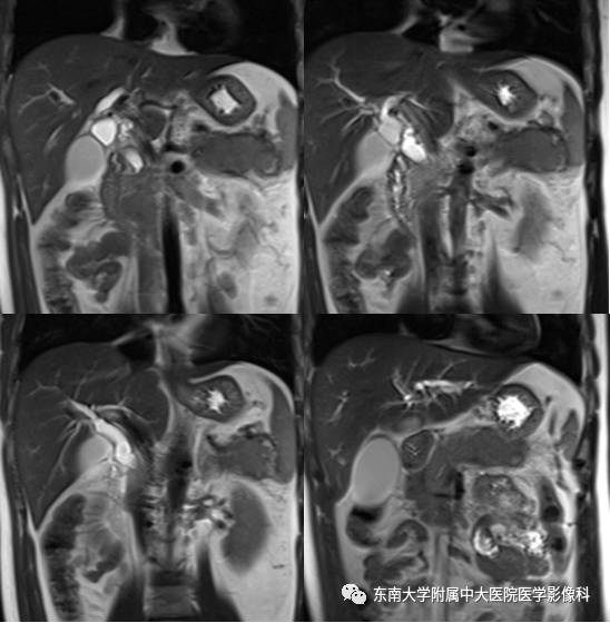 【病例】自身免疫性胰腺炎1例CT及MR影像表现