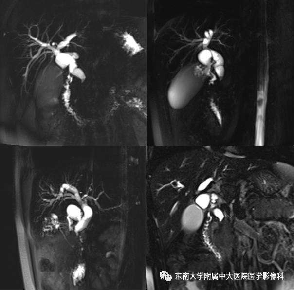 【病例】自身免疫性胰腺炎1例CT及MR影像表现