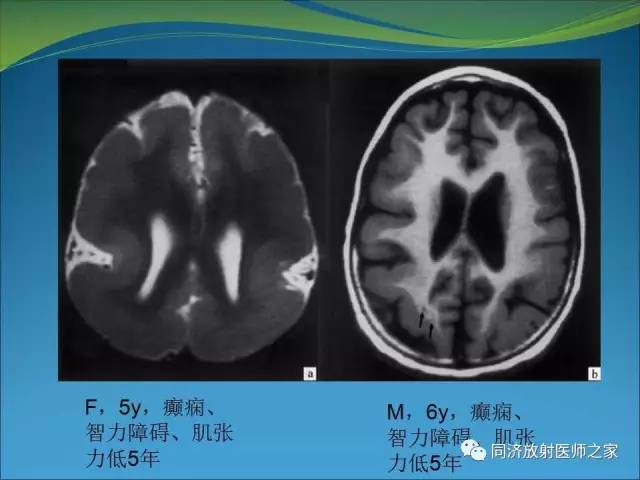 【PPT】神经元移行异常引起的颅脑畸形影像诊断
