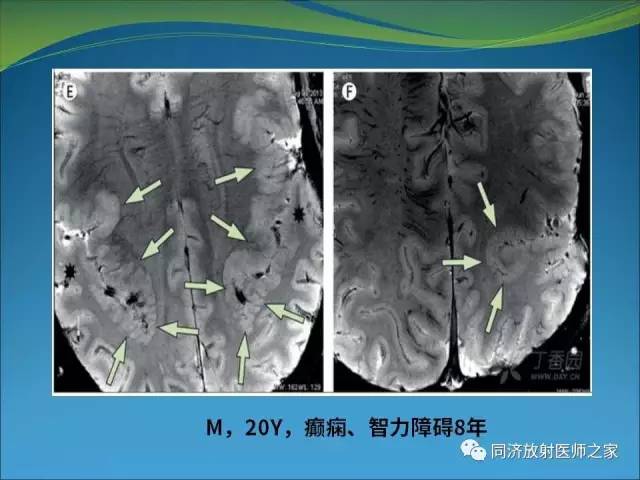 【PPT】神经元移行异常引起的颅脑畸形影像诊断