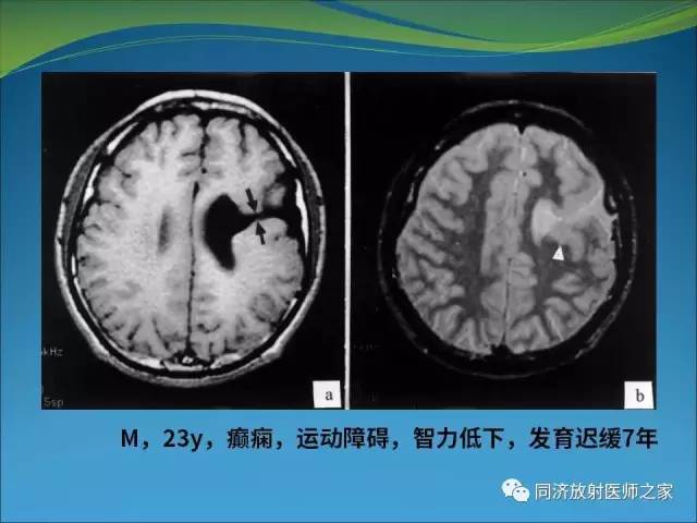 【PPT】神经元移行异常引起的颅脑畸形影像诊断