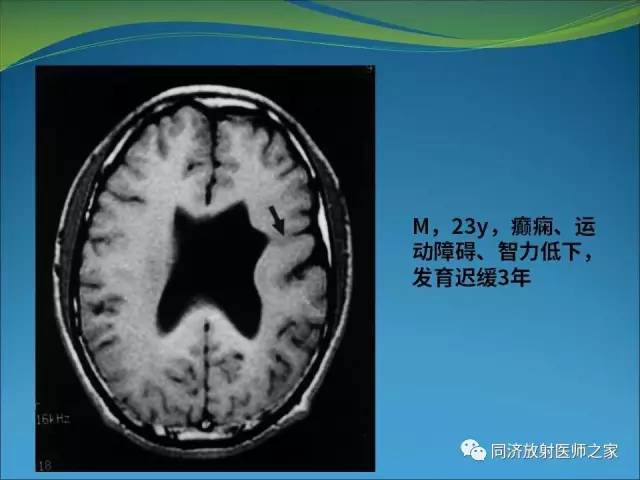 【PPT】神经元移行异常引起的颅脑畸形影像诊断