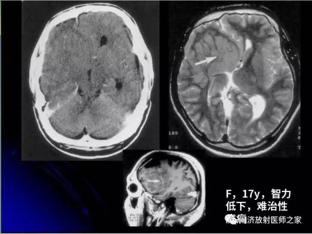 【PPT】神经元移行异常引起的颅脑畸形影像诊断