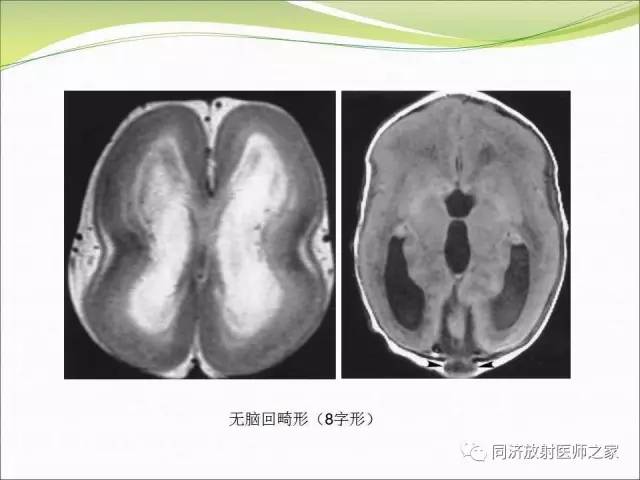 【PPT】神经元移行异常引起的颅脑畸形影像诊断