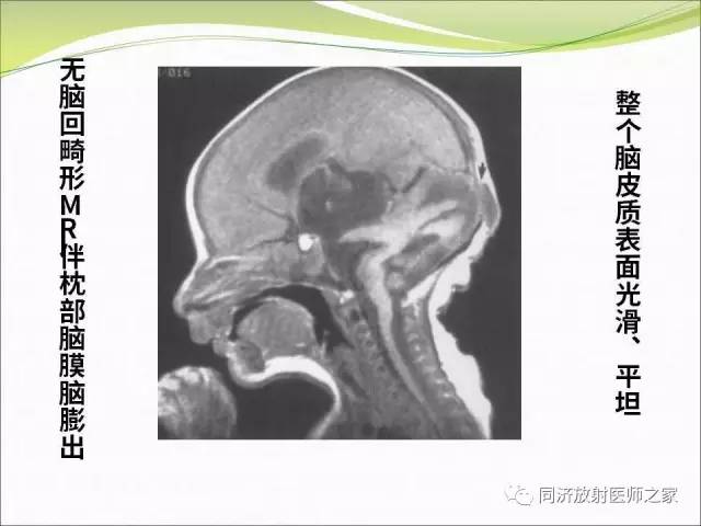 【PPT】神经元移行异常引起的颅脑畸形影像诊断