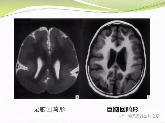 【PPT】神经元移行异常引起的颅脑畸形影像诊断