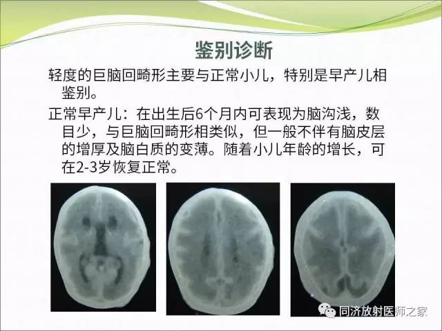 【PPT】神经元移行异常引起的颅脑畸形影像诊断