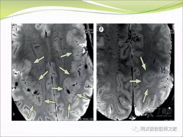 【PPT】神经元移行异常引起的颅脑畸形影像诊断