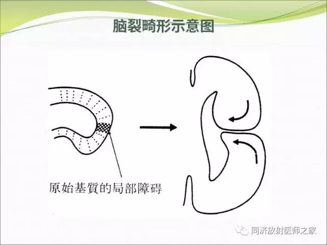 【PPT】神经元移行异常引起的颅脑畸形影像诊断