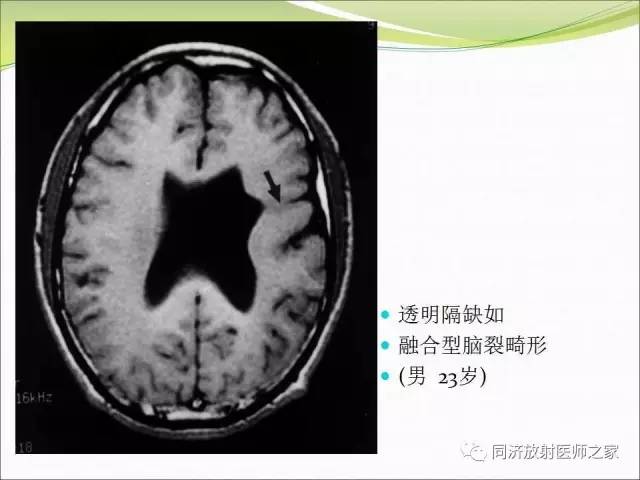 【PPT】神经元移行异常引起的颅脑畸形影像诊断