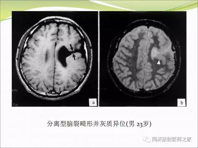 【PPT】神经元移行异常引起的颅脑畸形影像诊断