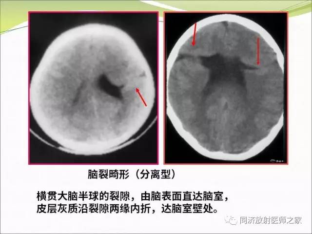【PPT】神经元移行异常引起的颅脑畸形影像诊断