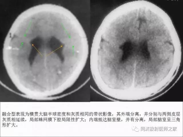 【PPT】神经元移行异常引起的颅脑畸形影像诊断