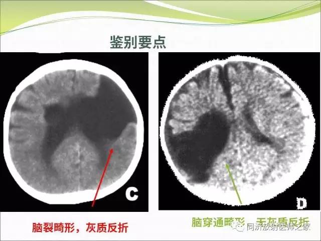 【PPT】神经元移行异常引起的颅脑畸形影像诊断
