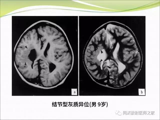 【PPT】神经元移行异常引起的颅脑畸形影像诊断