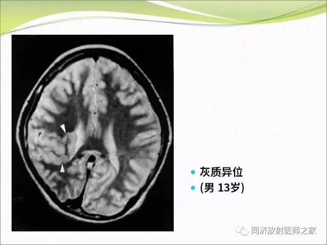 【PPT】神经元移行异常引起的颅脑畸形影像诊断