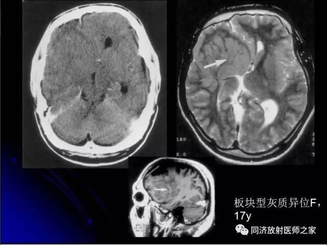 【PPT】神经元移行异常引起的颅脑畸形影像诊断