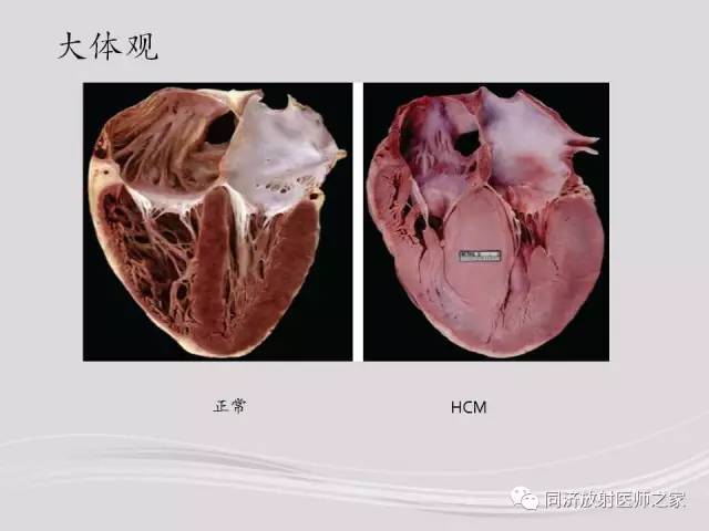 【PPT】心脏MRI基础及肥厚型心肌病诊断