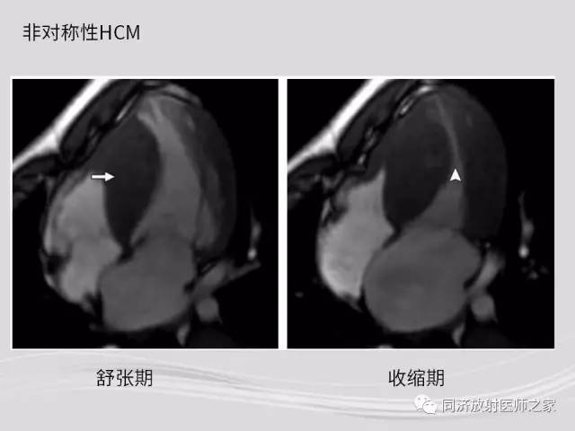 【PPT】心脏MRI基础及肥厚型心肌病诊断