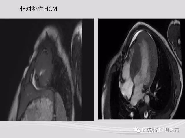 【PPT】心脏MRI基础及肥厚型心肌病诊断