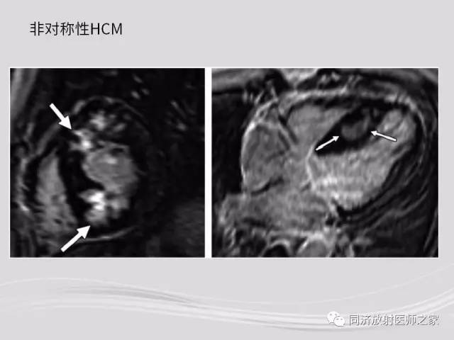 【PPT】心脏MRI基础及肥厚型心肌病诊断