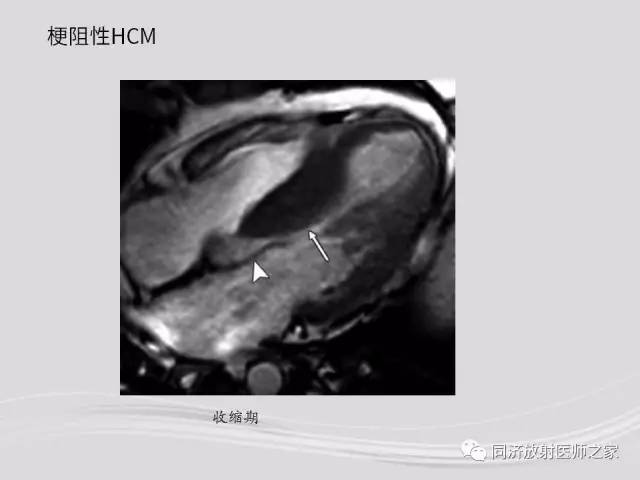 【PPT】心脏MRI基础及肥厚型心肌病诊断