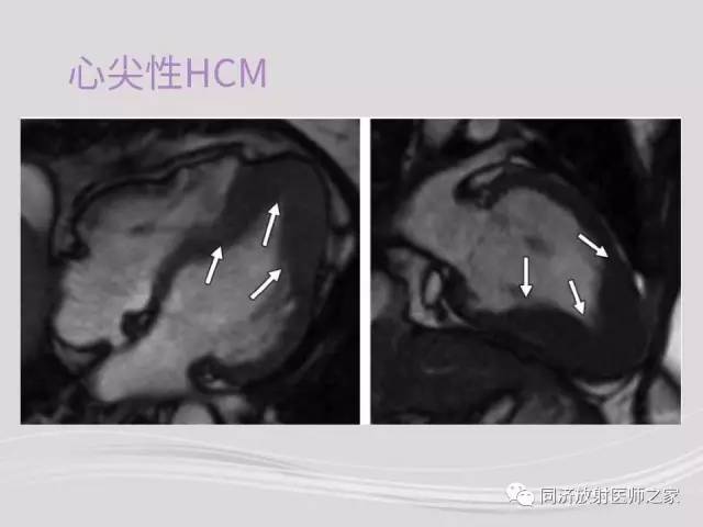 【PPT】心脏MRI基础及肥厚型心肌病诊断
