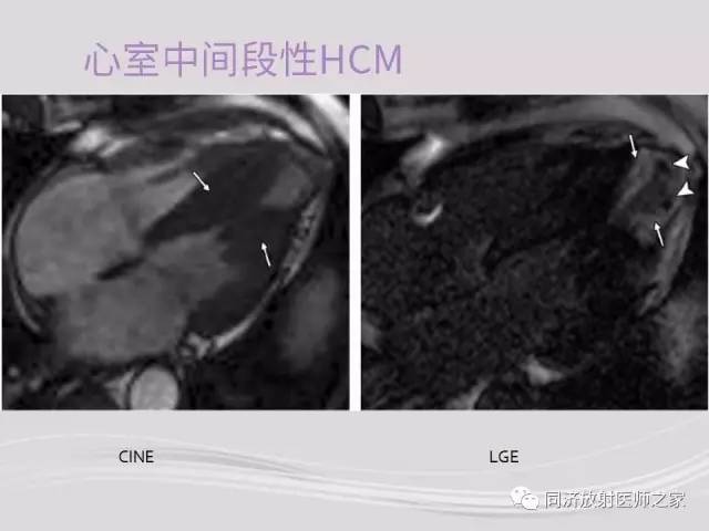 【PPT】心脏MRI基础及肥厚型心肌病诊断