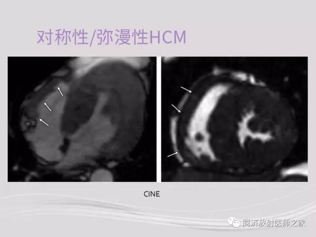 【PPT】心脏MRI基础及肥厚型心肌病诊断