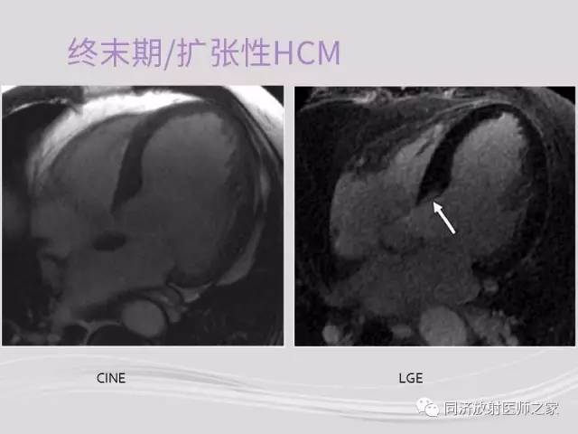 【PPT】心脏MRI基础及肥厚型心肌病诊断