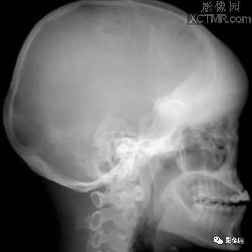 【病例】骨纤维异常增殖症1例X线影像表现