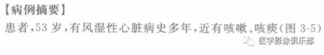 【病例】肺静脉曲张1例CT